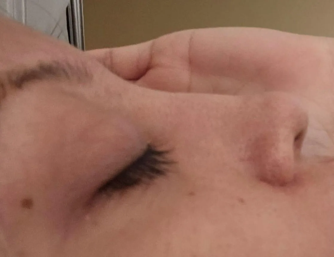 Patient rhinoplasty outcome photo