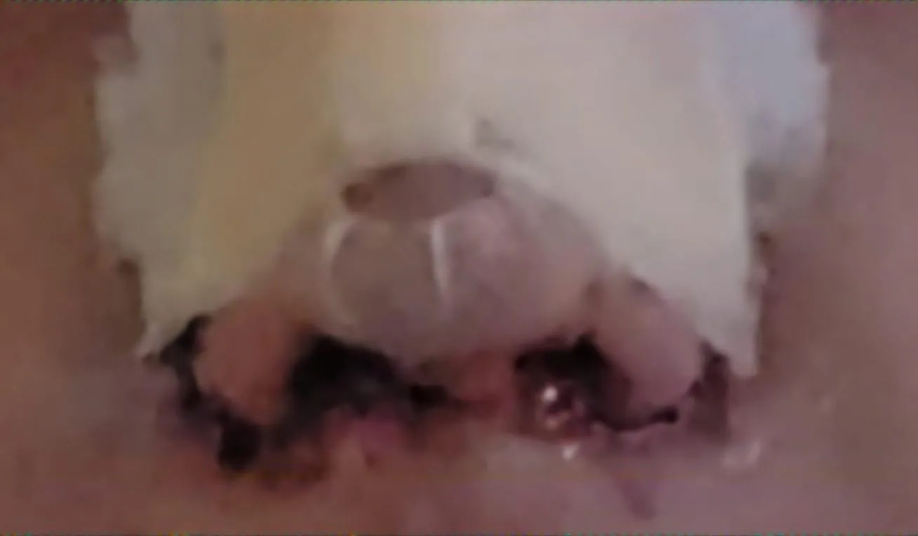 Patient rhinoplasty outcome photo