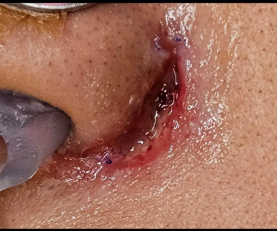 Patient rhinoplasty outcome photo