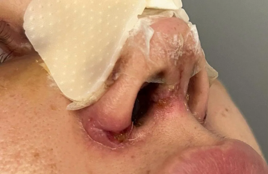 Patient rhinoplasty outcome photo