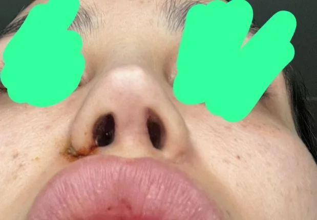 Patient rhinoplasty outcome photo