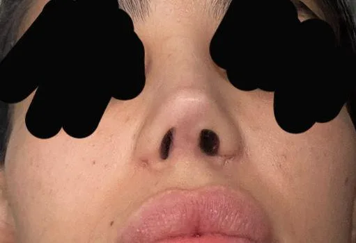Patient rhinoplasty outcome photo
