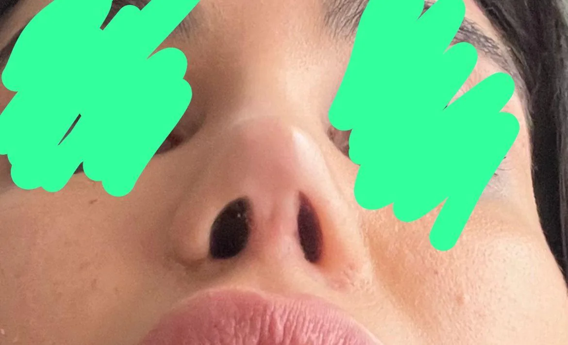 Patient rhinoplasty outcome photo