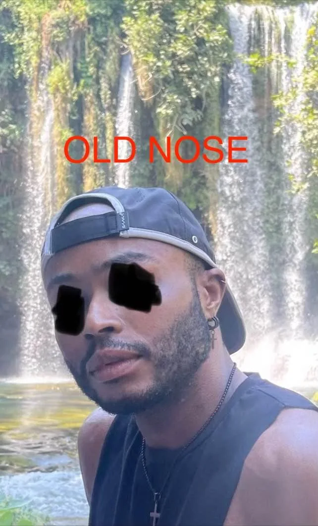 Patient nose before rhinoplasty