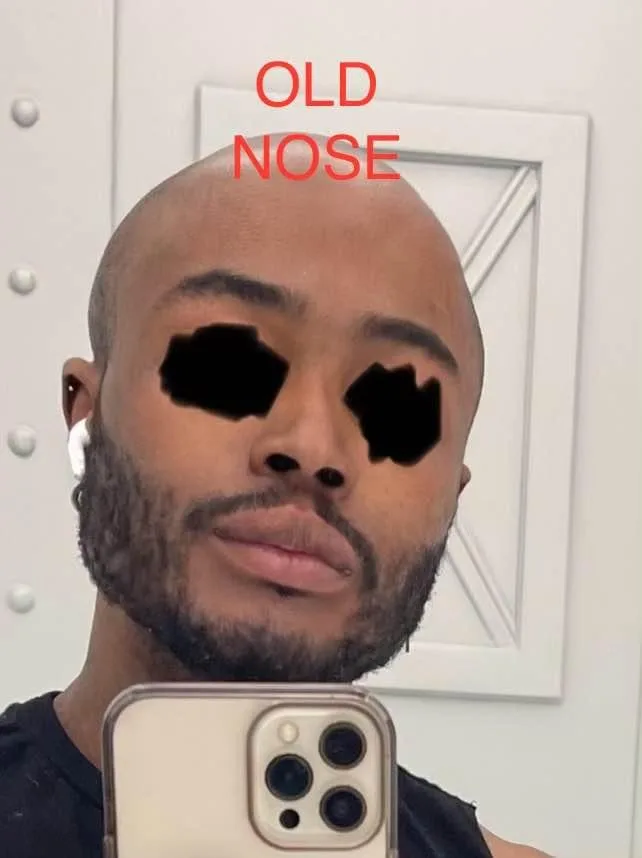 Patient nose before rhinoplasty