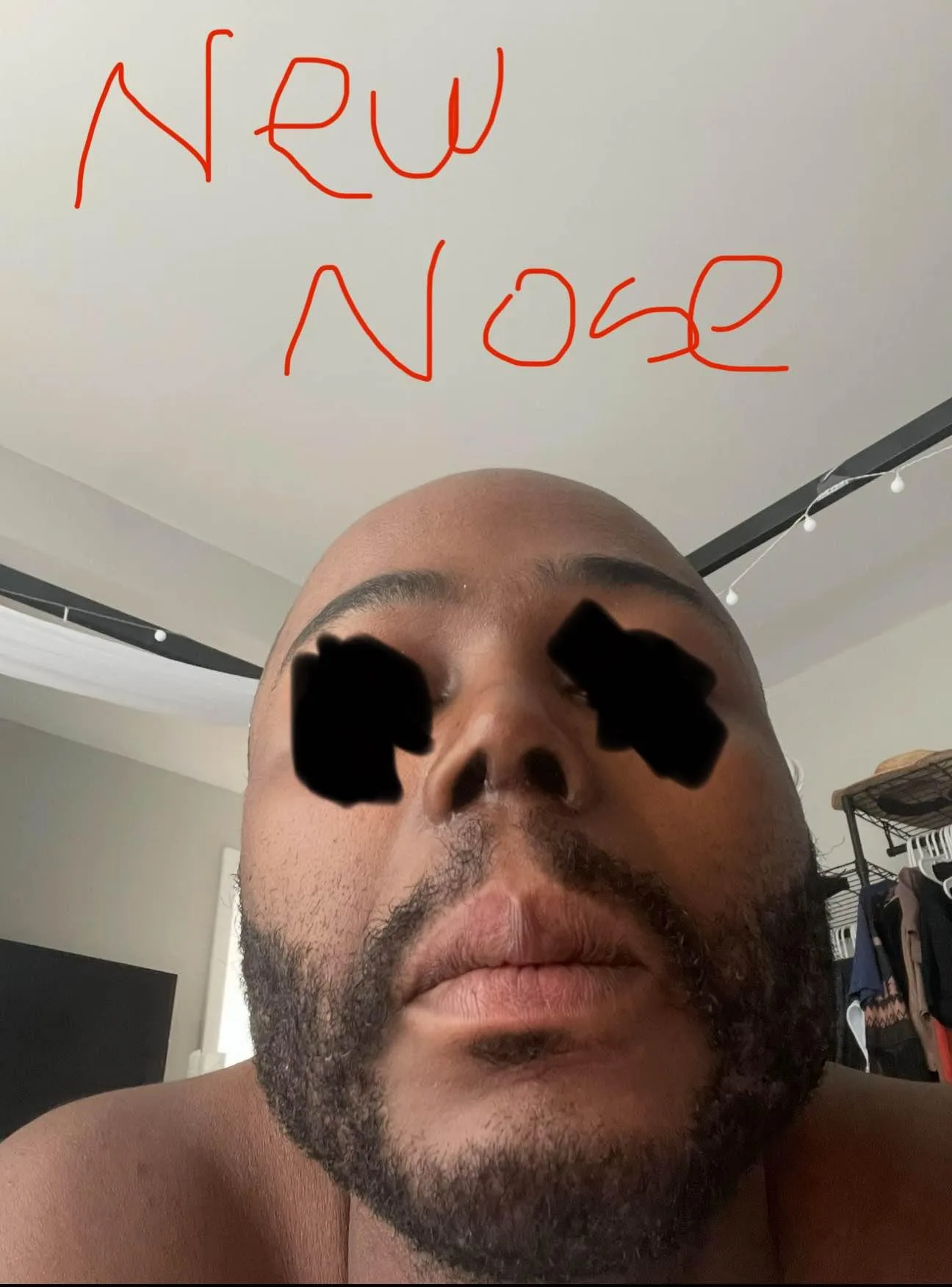 Patient nose after rhinoplasty