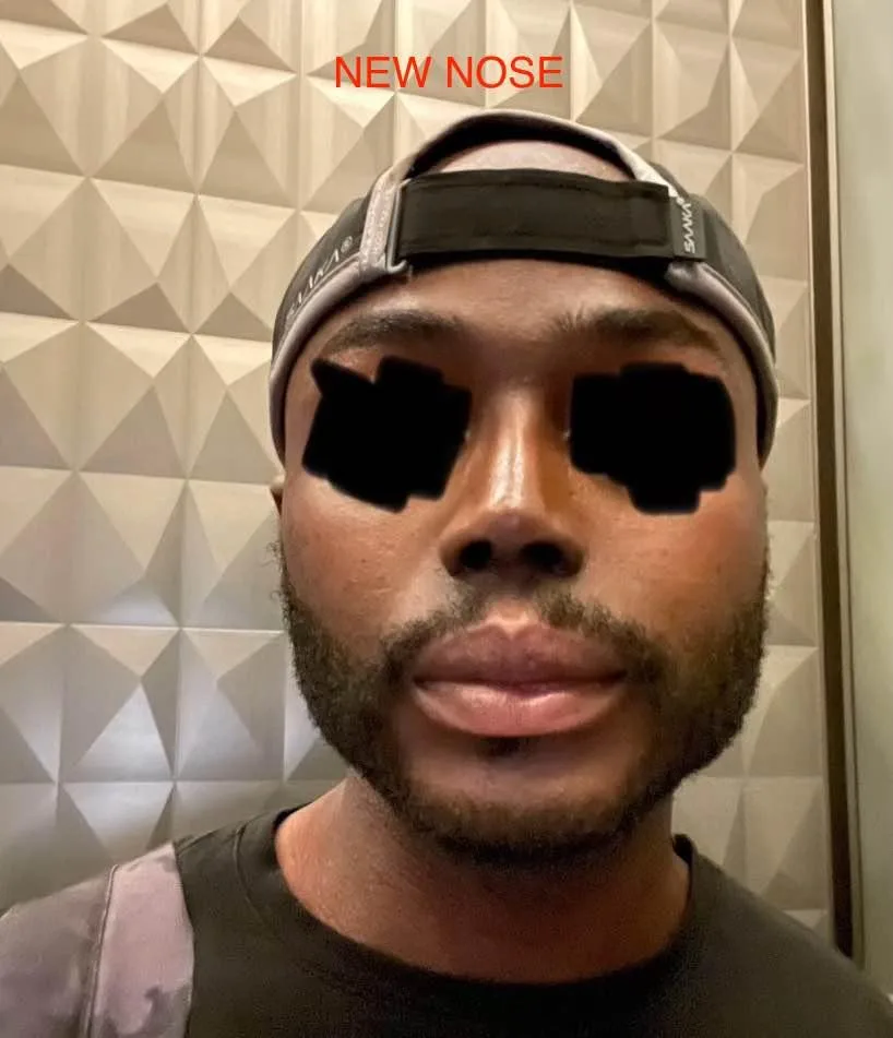 Patient nose after rhinoplasty