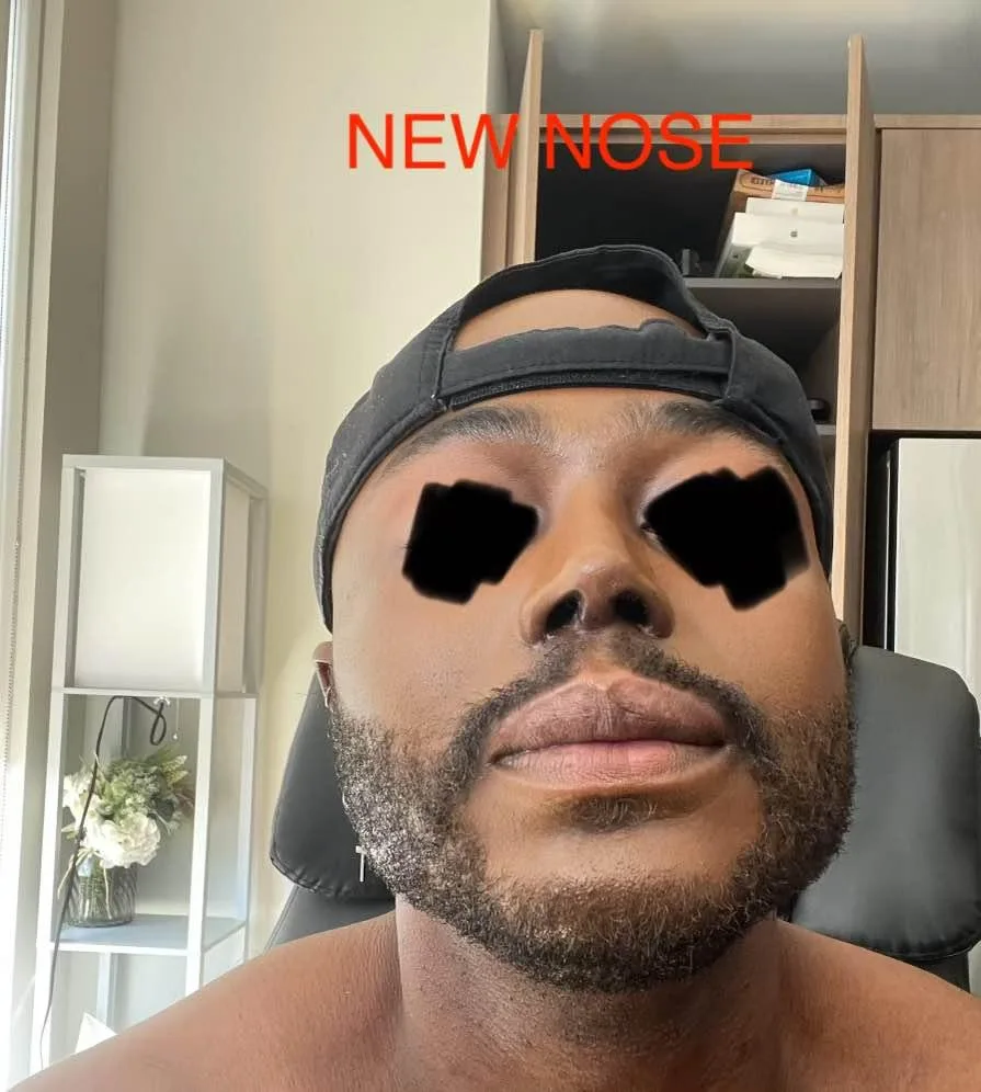 Patient nose after rhinoplasty