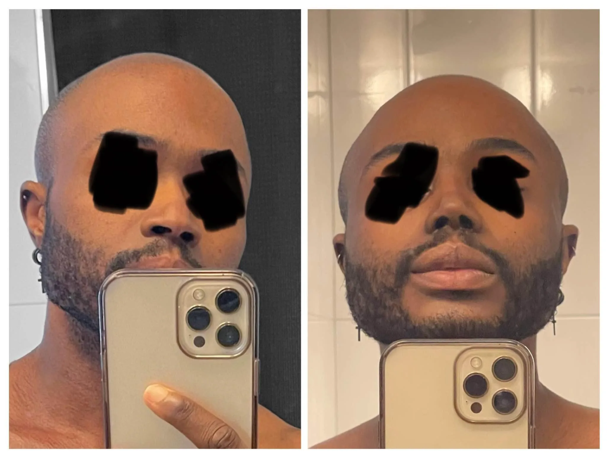 Patient nose after rhinoplasty