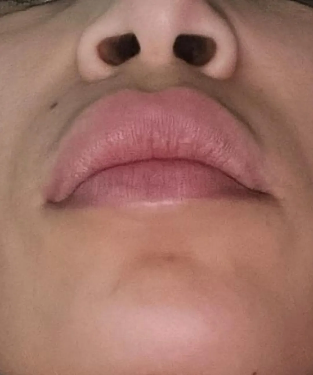 Patient rhinoplasty outcome photo