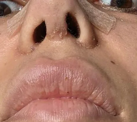 Patient rhinoplasty outcome photo