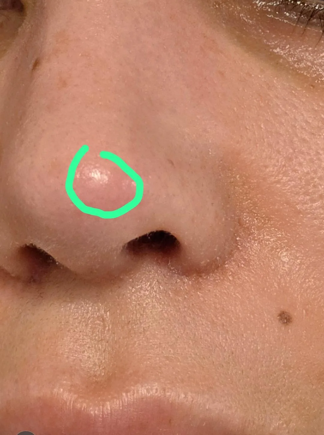 Patient rhinoplasty outcome photo