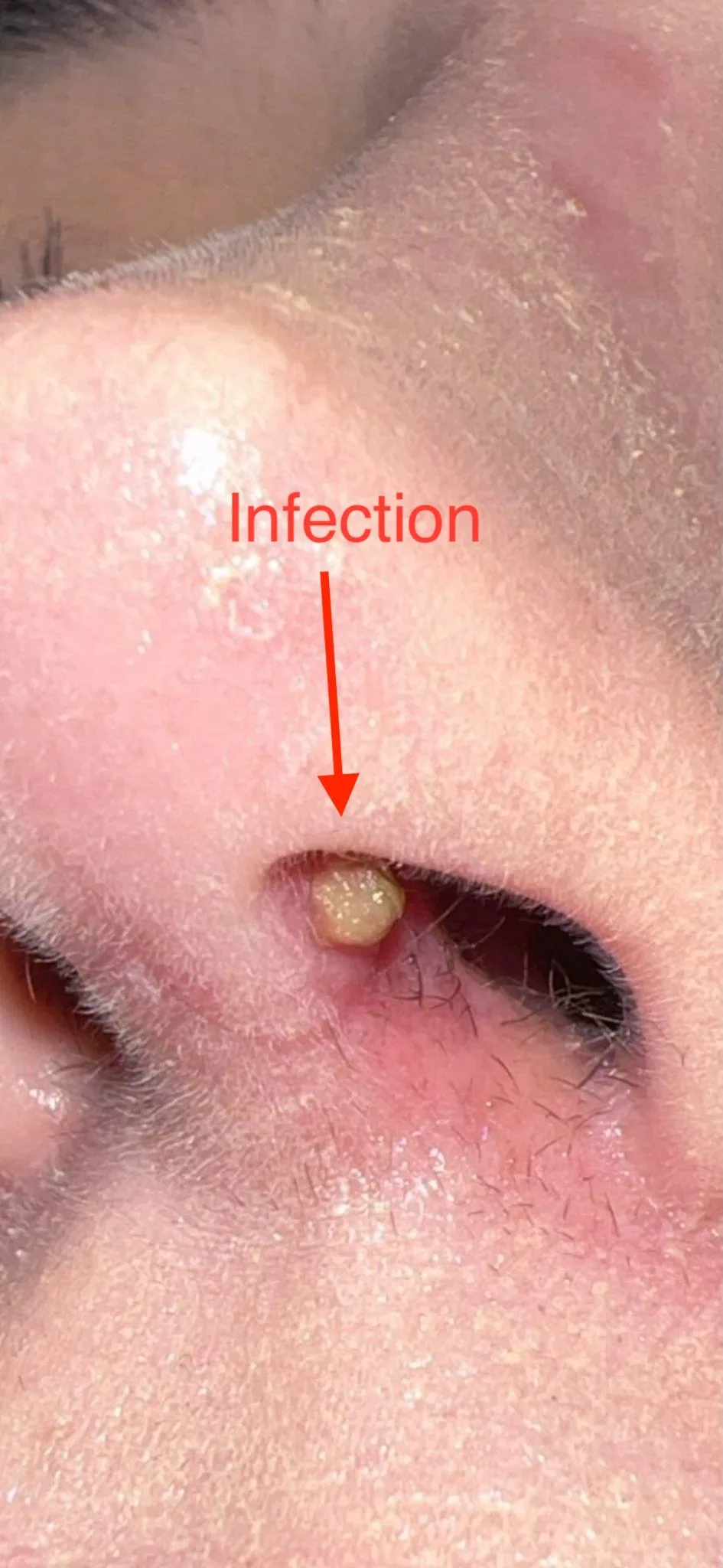 Patient rhinoplasty outcome photo