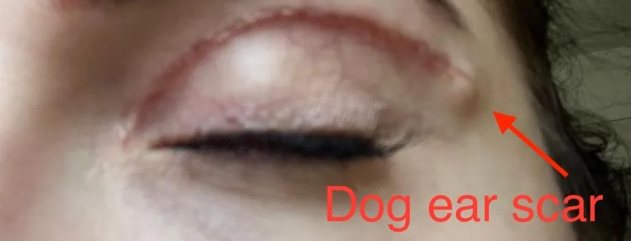 Patient rhinoplasty outcome photo