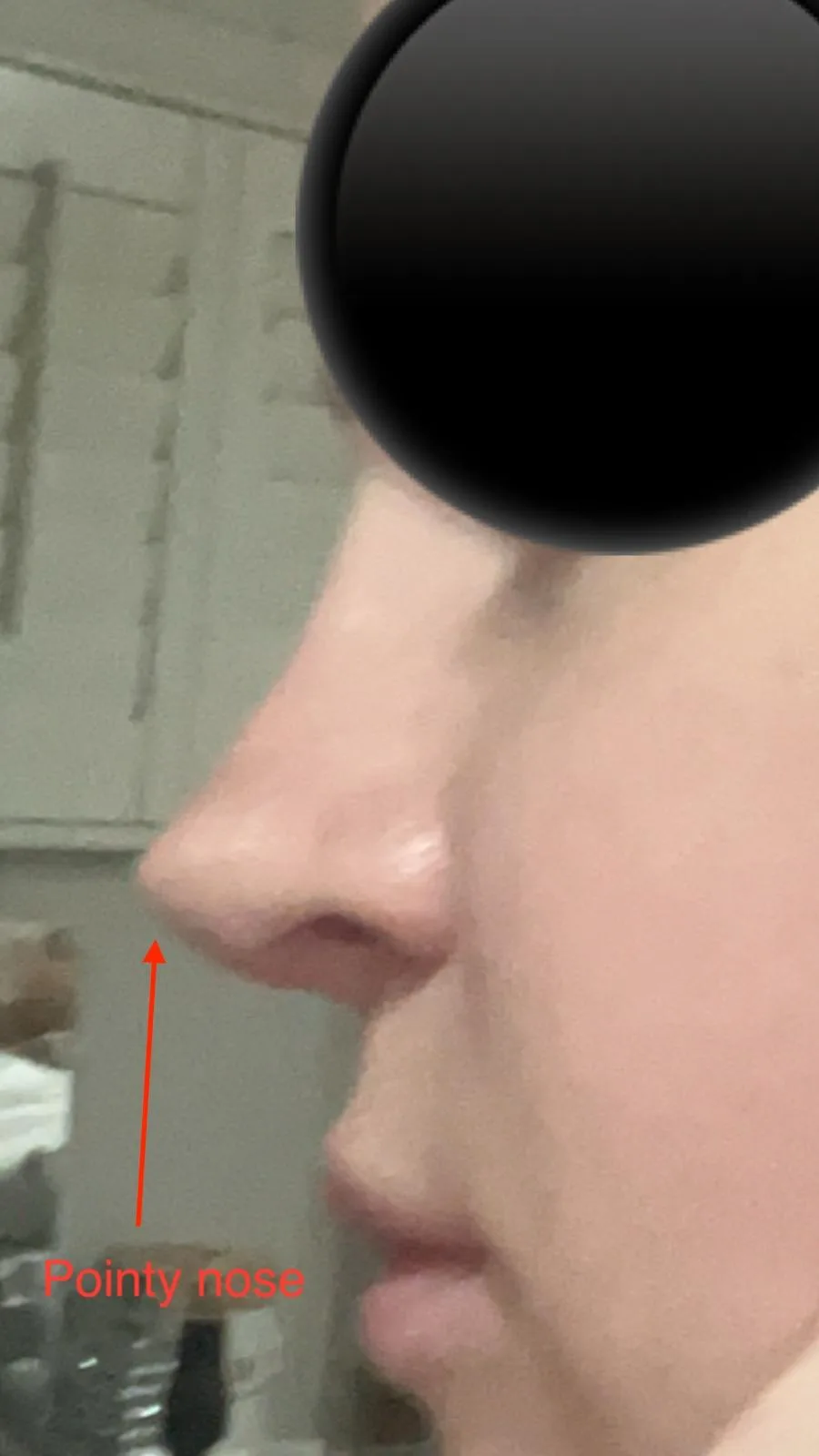 Patient rhinoplasty outcome photo