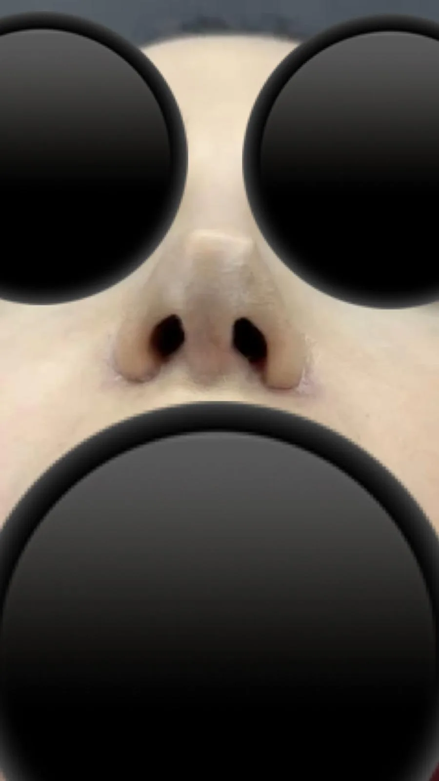 Patient rhinoplasty outcome photo