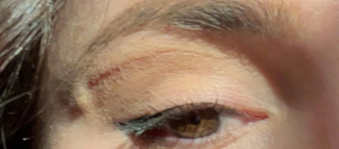 Patient rhinoplasty outcome photo