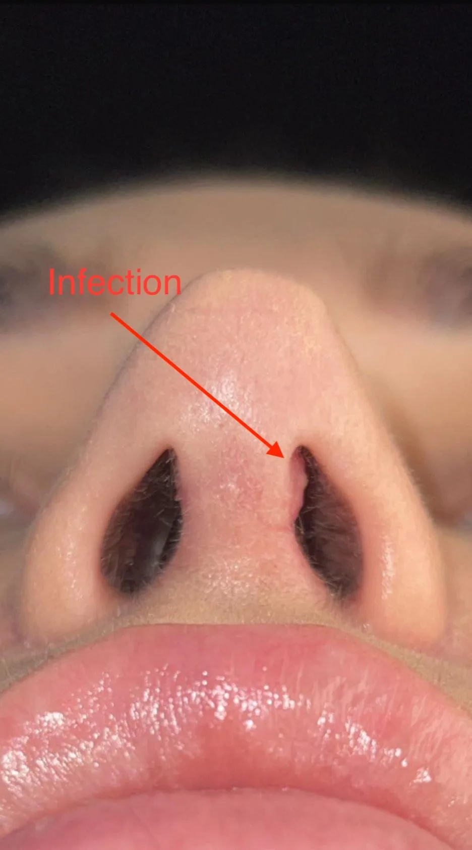 Patient rhinoplasty outcome photo