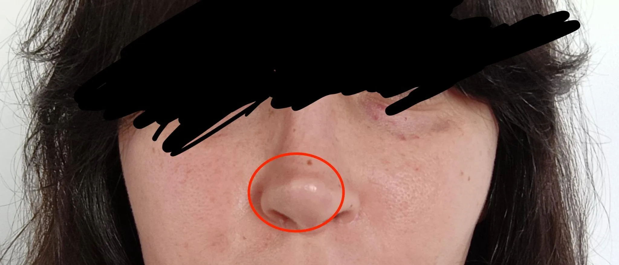 Patient rhinoplasty outcome photo