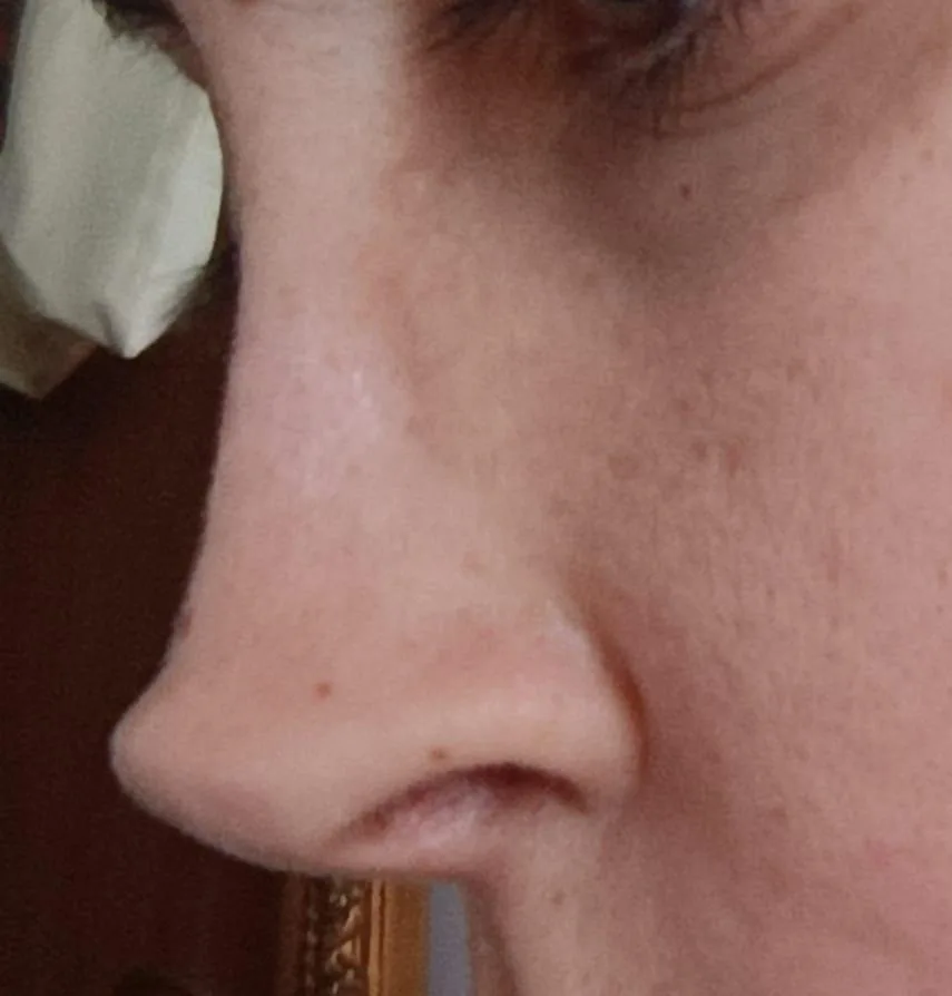 Patient rhinoplasty outcome photo