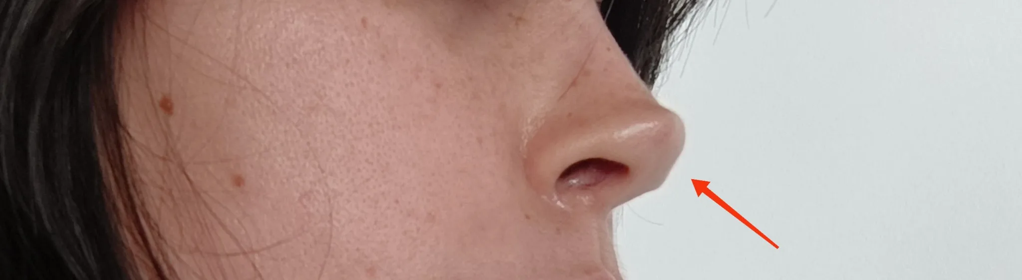Patient rhinoplasty outcome photo