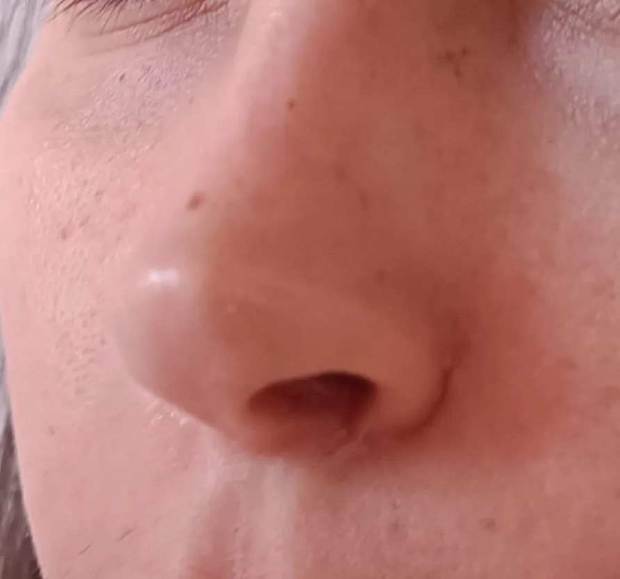 Patient rhinoplasty outcome photo