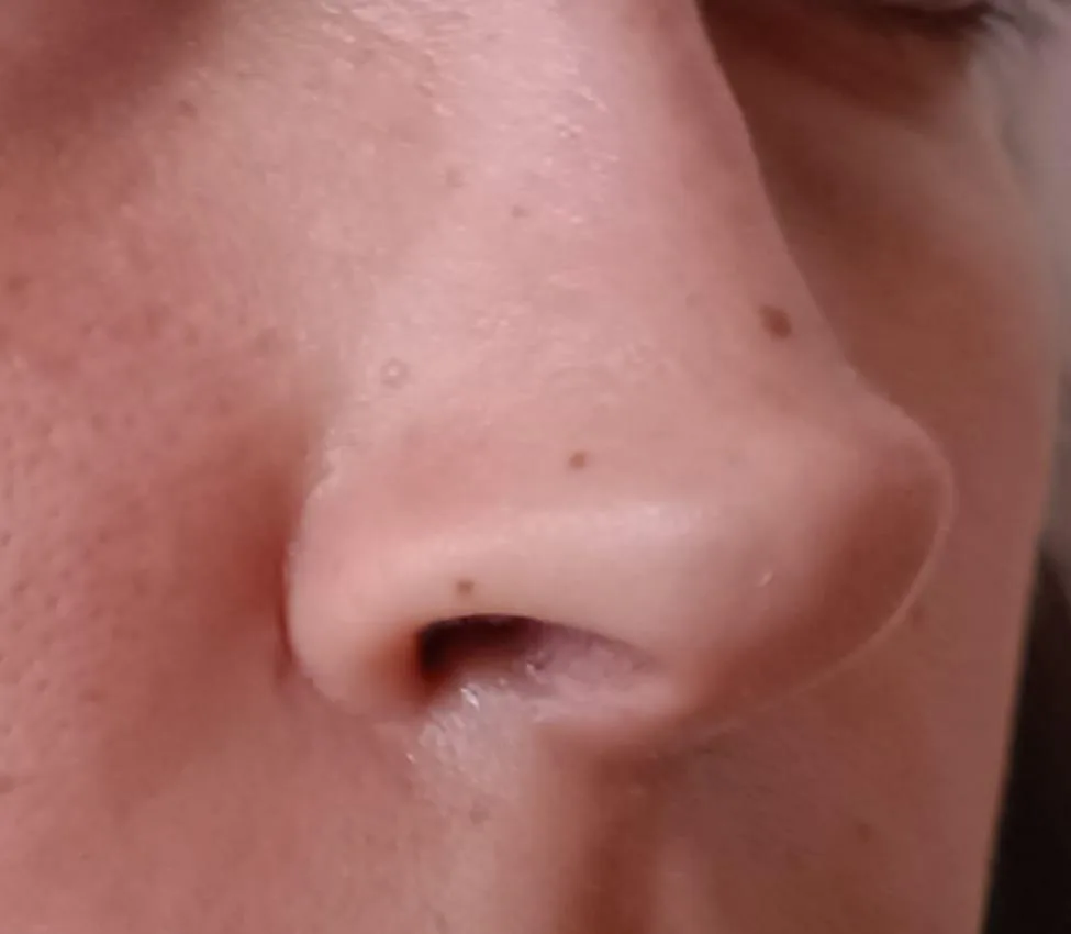 Patient rhinoplasty outcome photo
