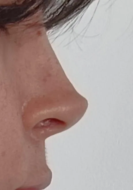 Patient rhinoplasty outcome photo