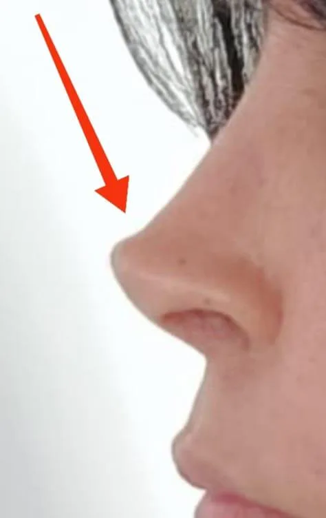 Patient rhinoplasty outcome photo