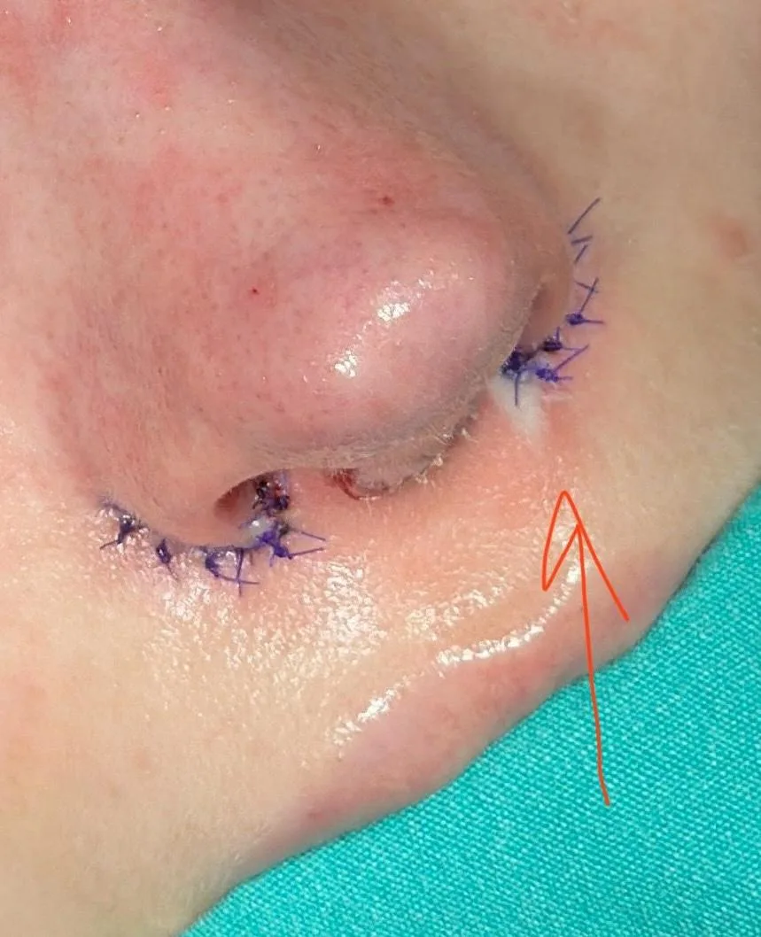 Patient rhinoplasty outcome photo
