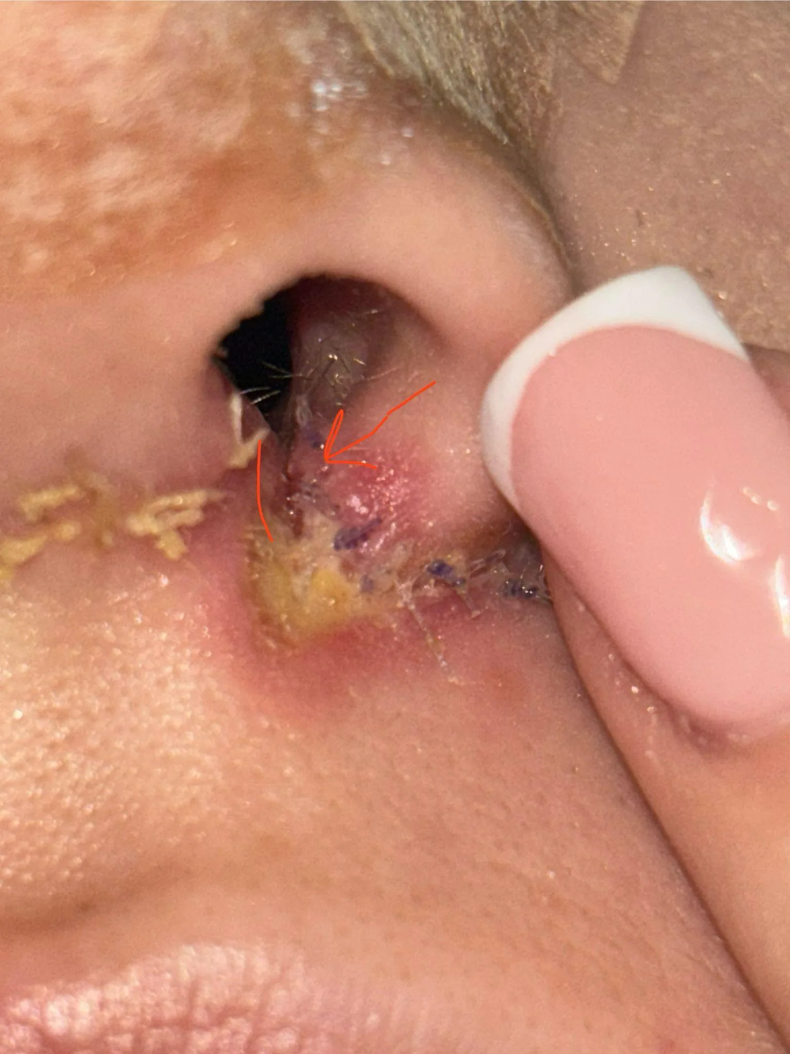 Patient rhinoplasty outcome photo