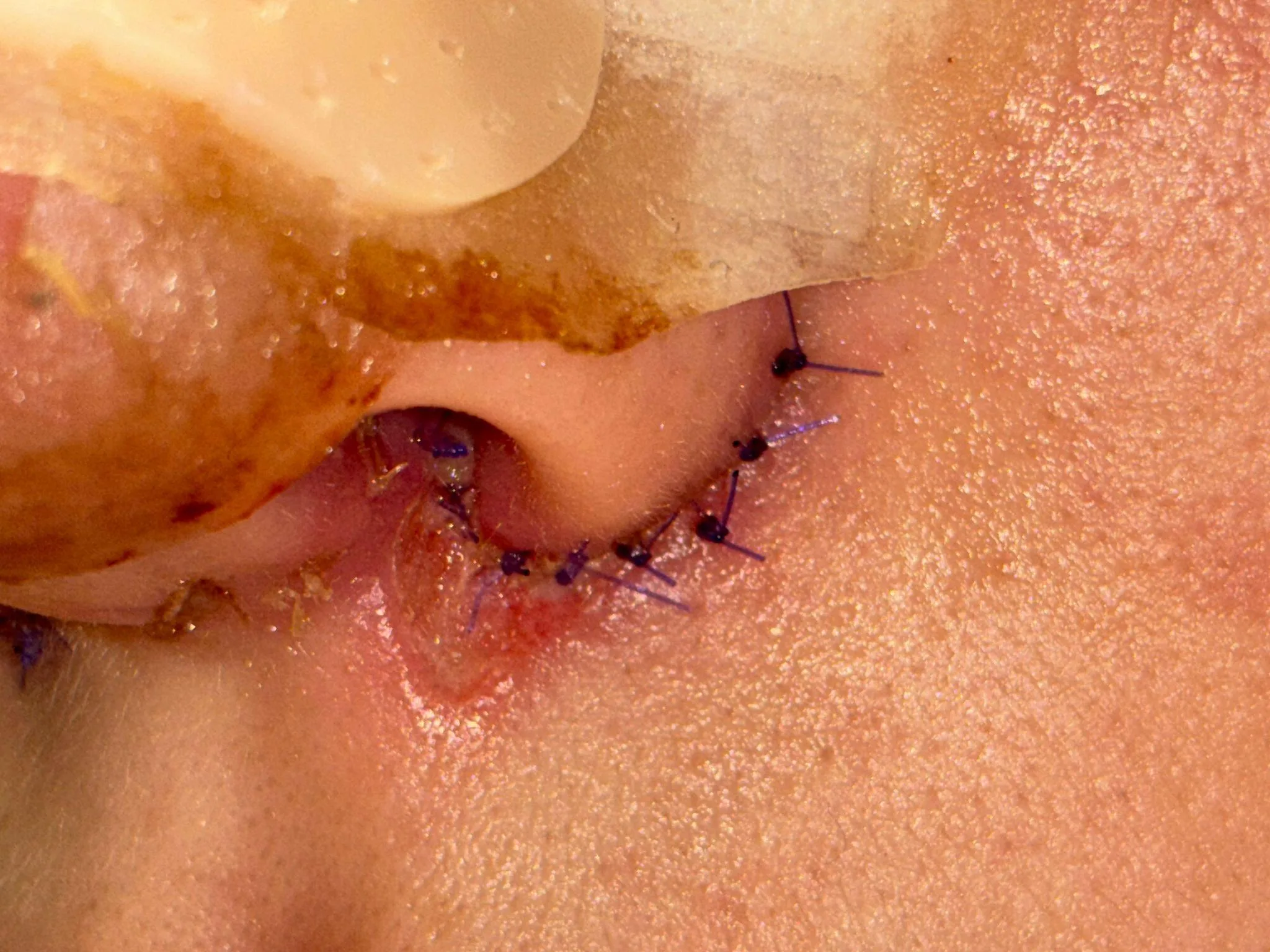 Patient rhinoplasty outcome photo