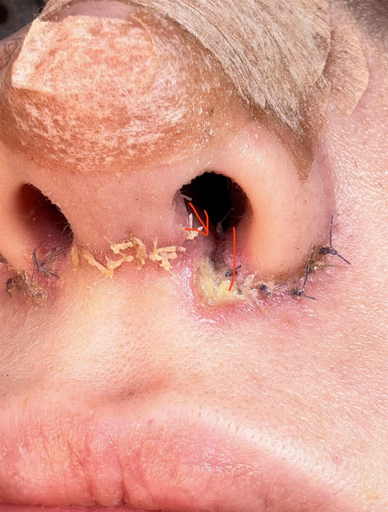 Patient rhinoplasty outcome photo