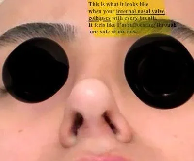 Patient rhinoplasty outcome photo