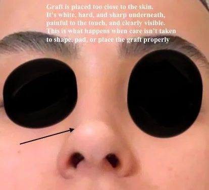 Patient rhinoplasty outcome photo