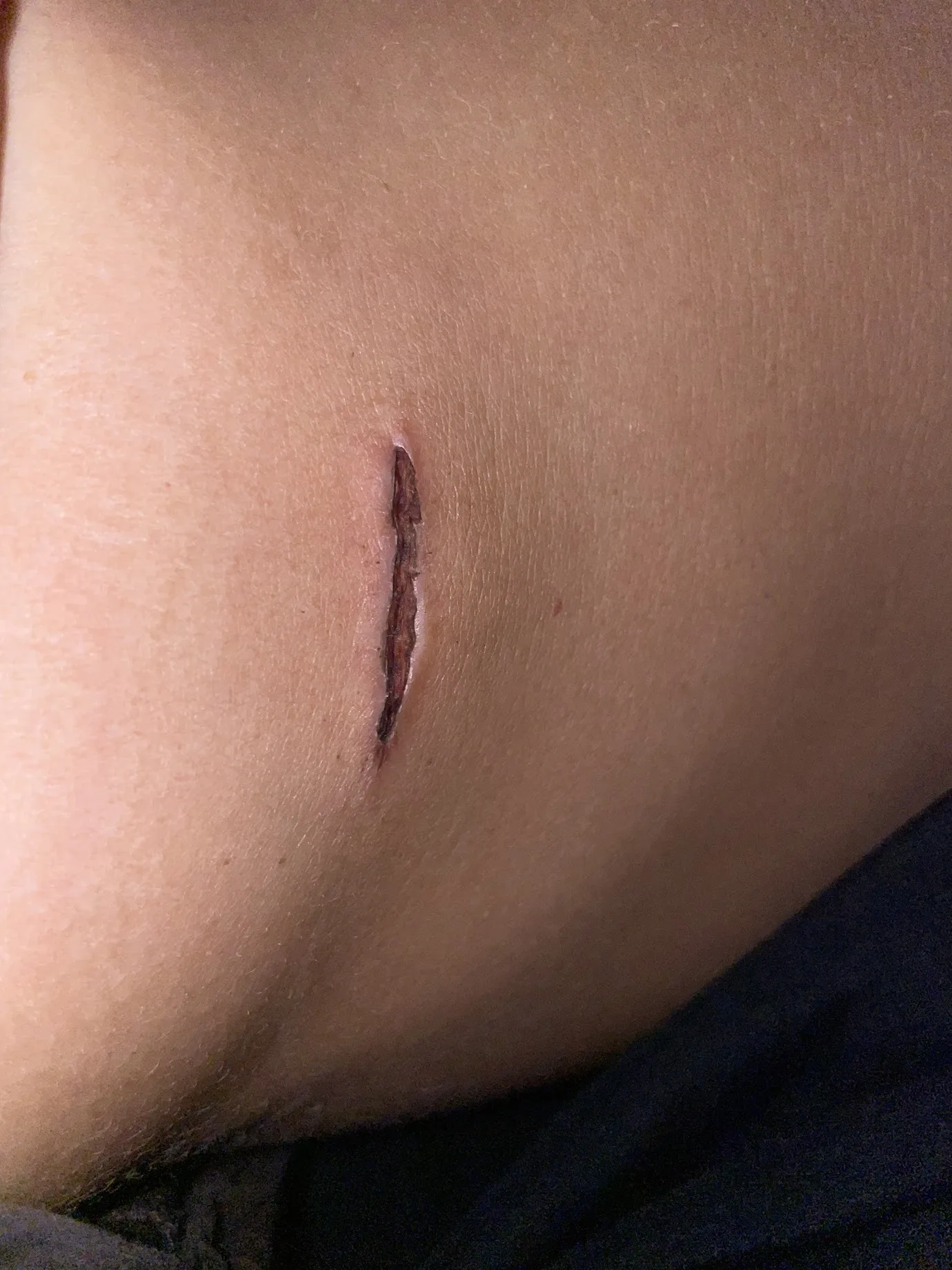 Patient rhinoplasty outcome photo