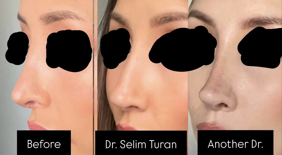 Patient rhinoplasty outcome photo