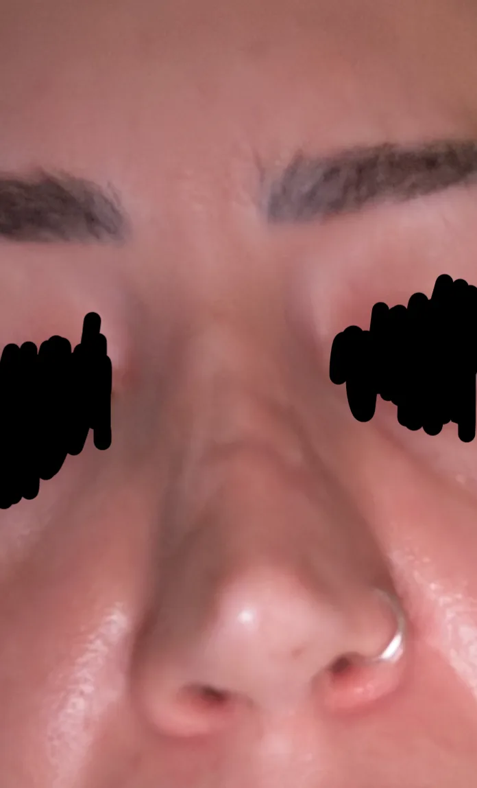 Patient rhinoplasty outcome photo