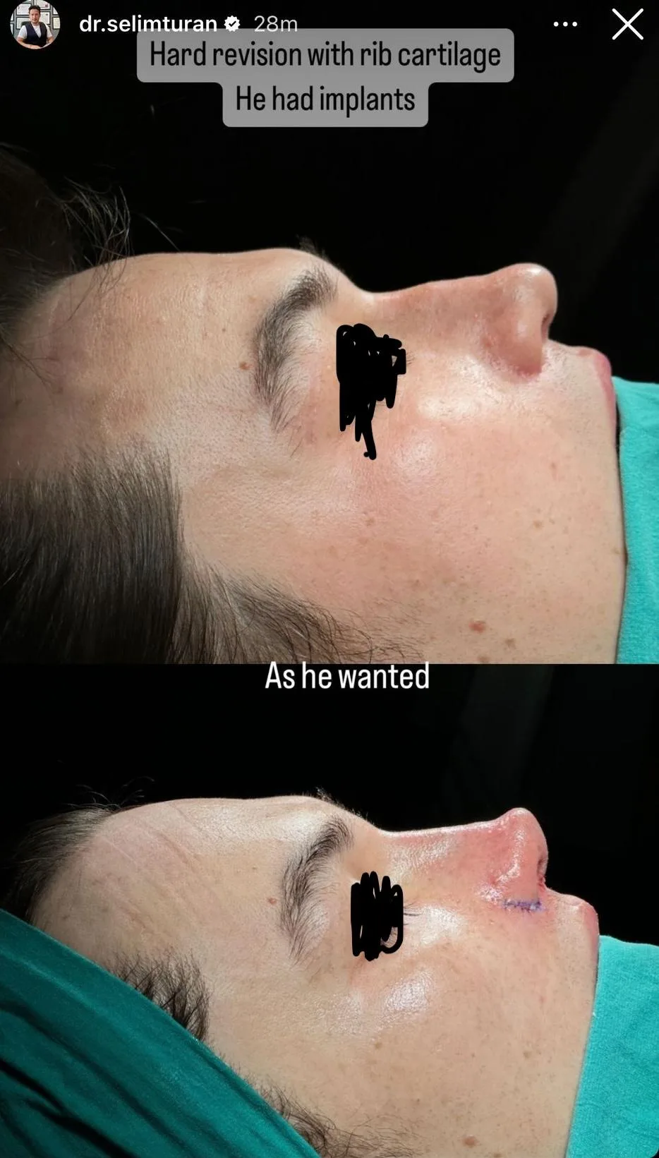 Patient rhinoplasty outcome photo