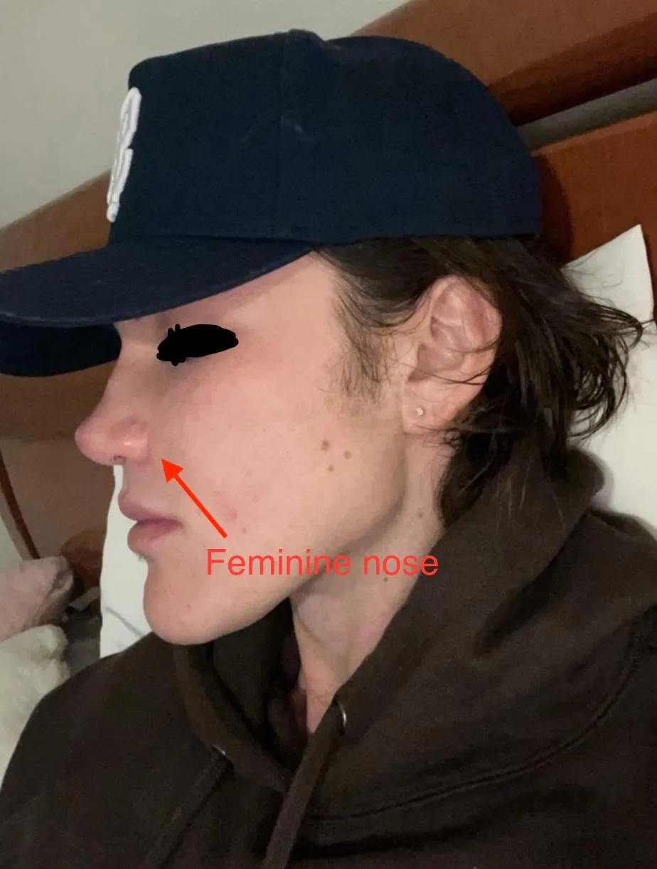 Patient rhinoplasty outcome photo