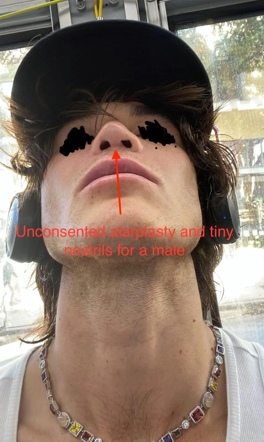 Patient rhinoplasty outcome photo