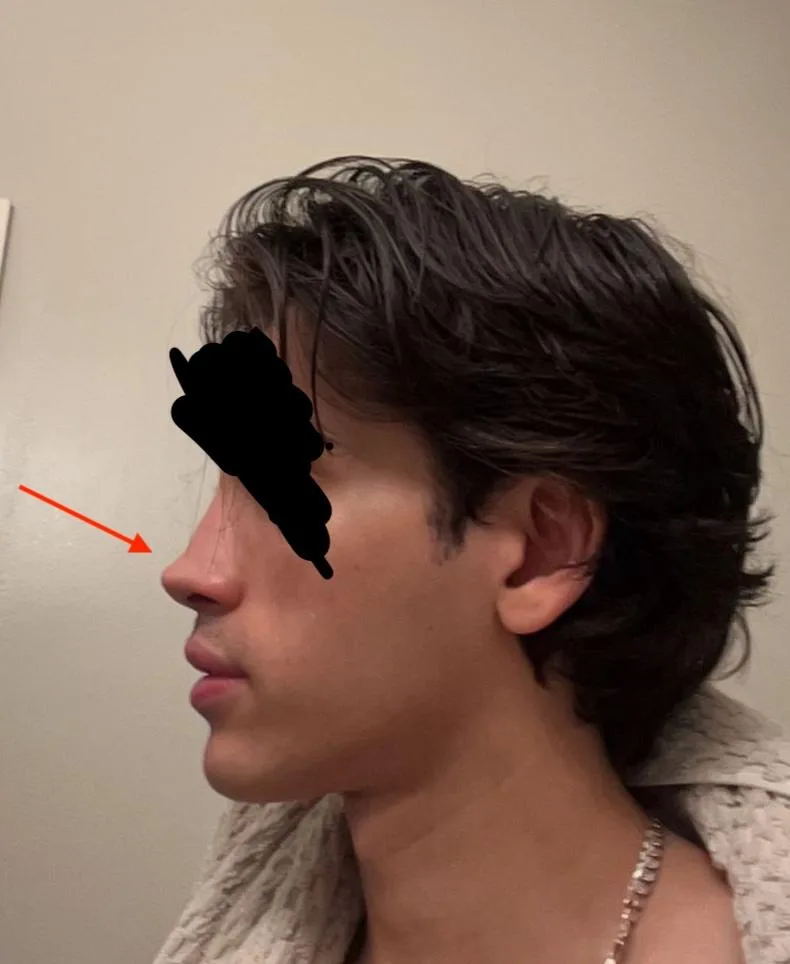 Patient rhinoplasty outcome photo