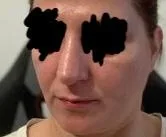 Patient rhinoplasty outcome photo