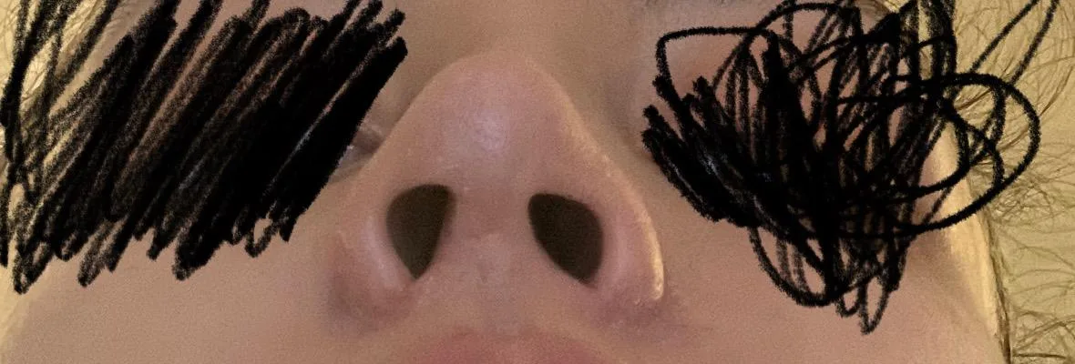 Patient rhinoplasty outcome photo