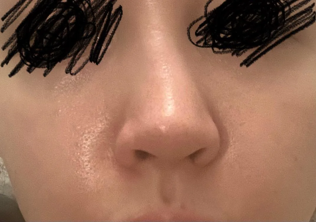 Patient rhinoplasty outcome photo